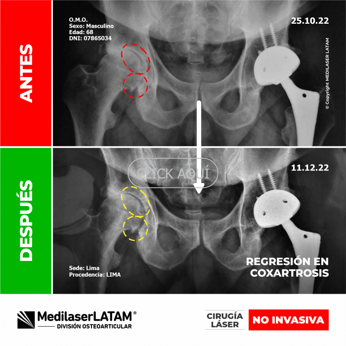 Evidencia en Coxartrosis – Oswaldo Marrujo TAC comparativo demuestra regeneración articular en cadera izquierda severa.