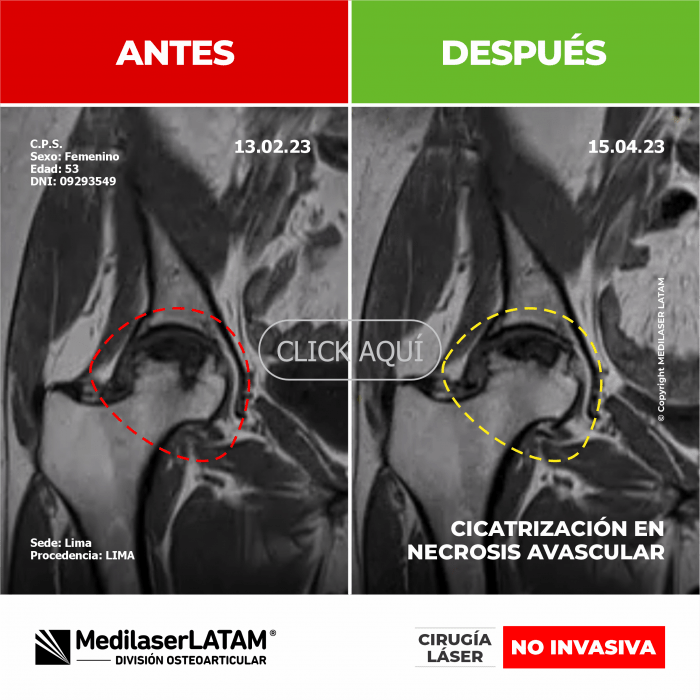 Evidencia en Necrosis Avascular – Clorinda Ponte Radiografías comparativas demuestran regeneración ósea en cadera con necrosis.