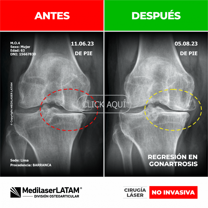Evidencia en Regresión de Gonartrosis – Melita Ontaneda Imágenes comparativas que demuestran recuperación en rodilla izquierda.