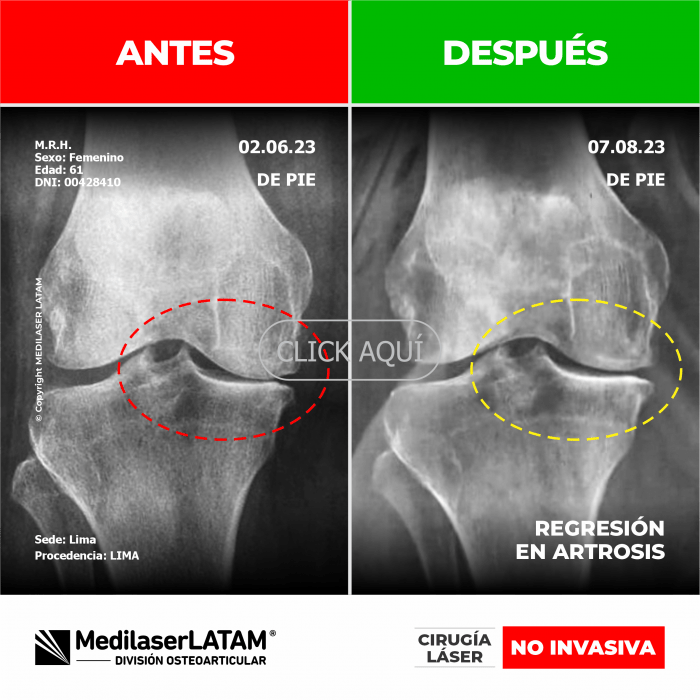Evidencia de Regresión Artrosis – Marina Rueda Radiografías seriadas que muestran reversión de daño articular multifocal.