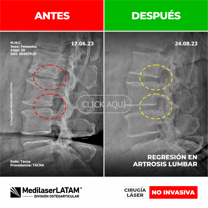 Evidencia de Regresión Lumbar – Martina Melendez Video caso con pruebas de mejoría en artrosis vertebral. Resultados medibles.