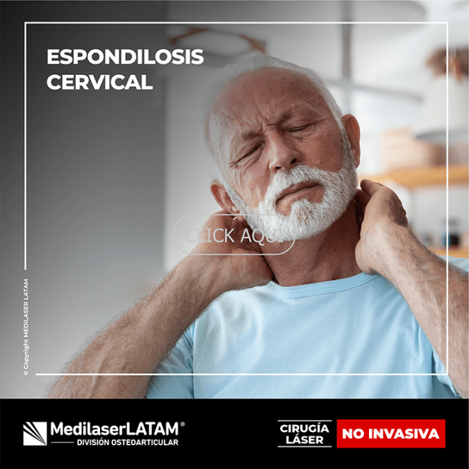 Espondilosis cervical: tratamiento láser para osteofitos y compresión nerviosa. Técnica con 12 años de validación científica.