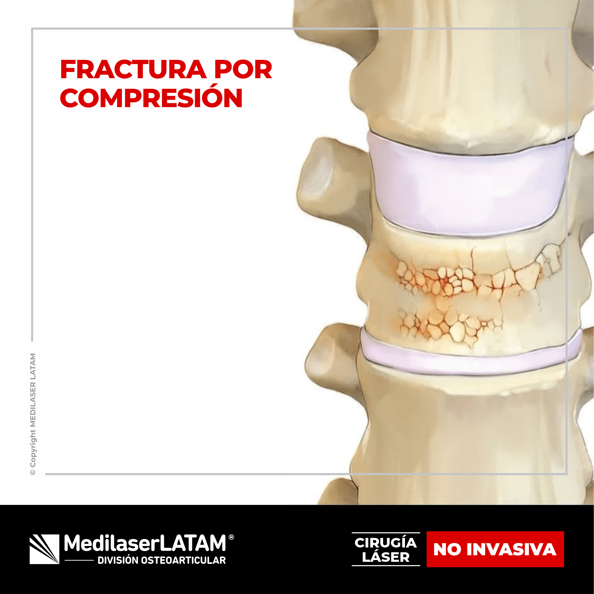 Fractura por compresión: tratamiento láser que alivia dolor y consolida vértebras sin cirugía. 90% de éxito en pacientes.