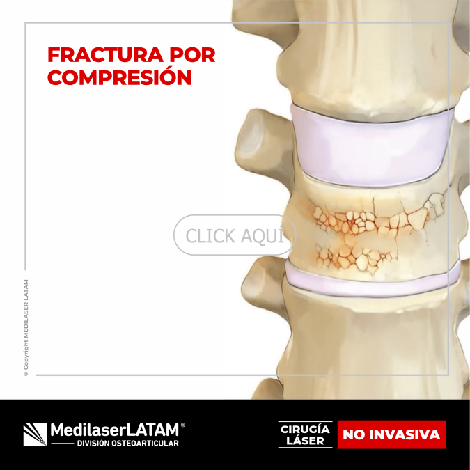 Fractura por compresión: tratamiento láser que alivia dolor y consolida vértebras sin cirugía. 90% de éxito en pacientes.