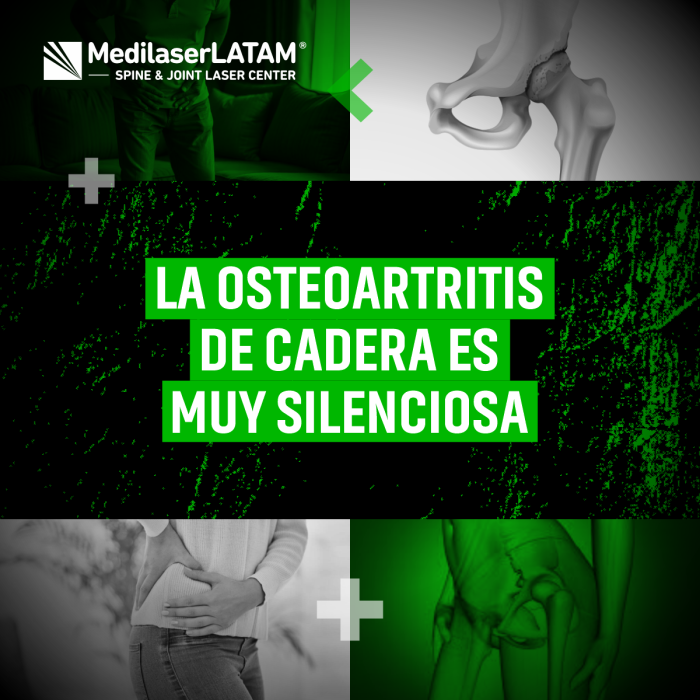 Osteoartritis de cadera: avanza sin dolor al inicio. Diagnóstico temprano con imágenes y tratamientos para frenar su progreso.