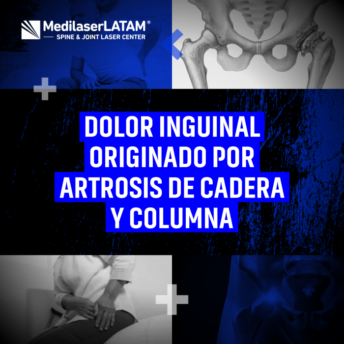 ¿Dolor inguinal por artrosis? Descubre cómo la cadera y columna lo causan. Soluciones integrales sin cirugía.