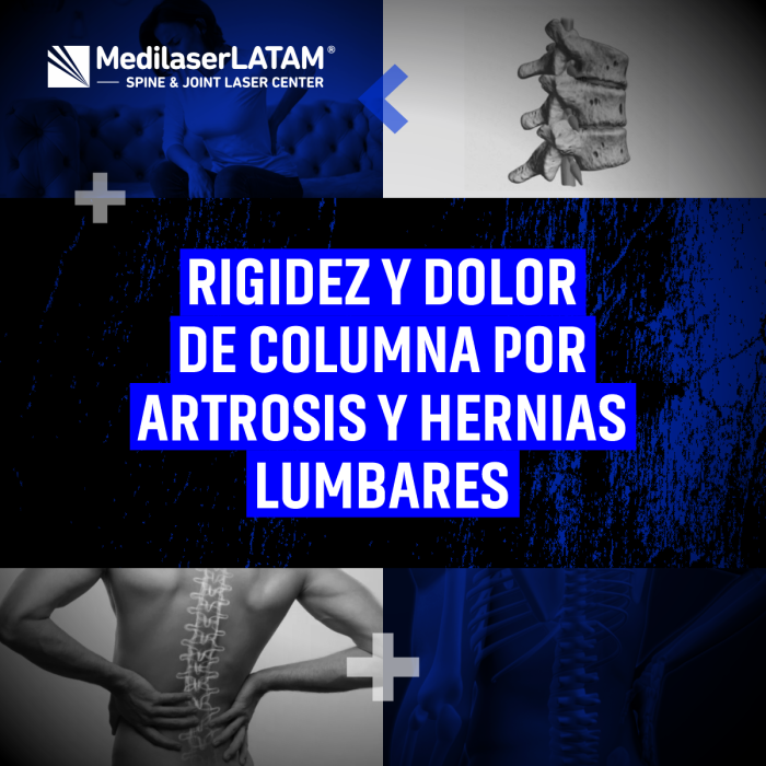 Rigidez matutina + dolor lumbar: ¿artrosis o hernia? Descubre tratamientos duales para recuperar flexibilidad.