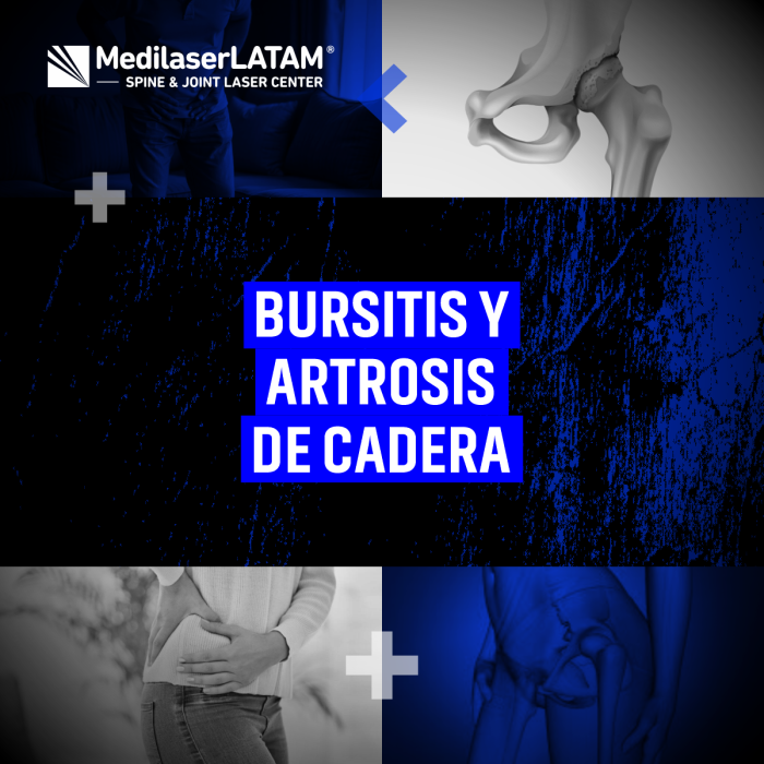 Bursitis + artrosis de cadera: combo doloroso. Terapias combinadas para reducir inflamación y regenerar articulaciones.