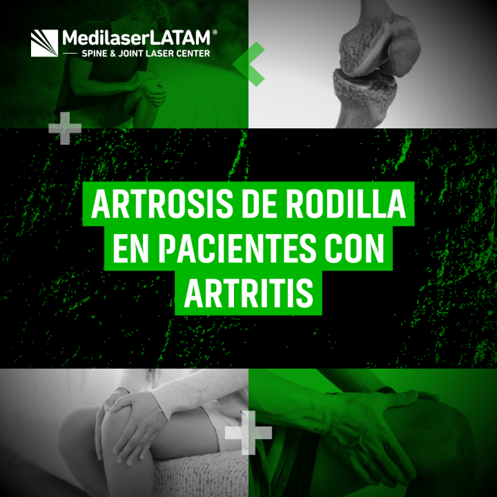 ¿Artritis reumatoide y dolor de rodilla? Descubre tratamientos para artrosis secundaria. Alivio sin cirugía con terapias especializadas