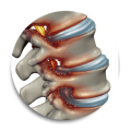 Tratamiento láser para hernias discales y dolor lumbar. Sin incisiones, sin riesgos quirúrgicos. Alta el mismo día y recuperación acelerada.