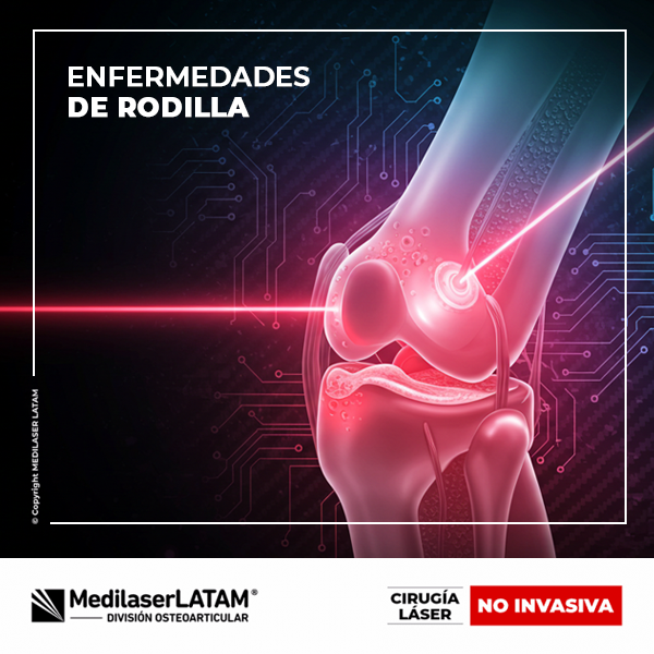 Repara meniscos y cartílago dañado con láser. Olvídate de las cirugías abiertas. Movilidad restaurada en poco tiempo.