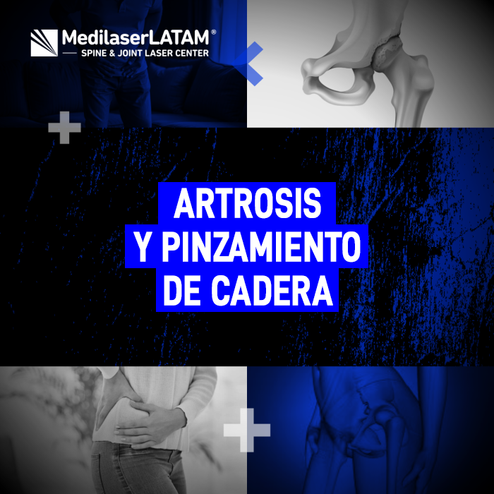 Evita la prótesis de cadera. Descubre cómo la artrosis y el pinzamiento de cadera progresan y qué puedes hacer para frenar el daño articular.