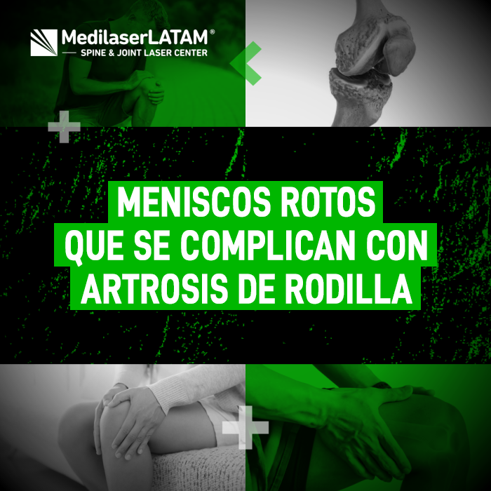 Un menisco roto puede llevar a artrosis. Conoce cómo prevenir y tratar esta complicación para proteger tu rodilla y mantenerte activo.