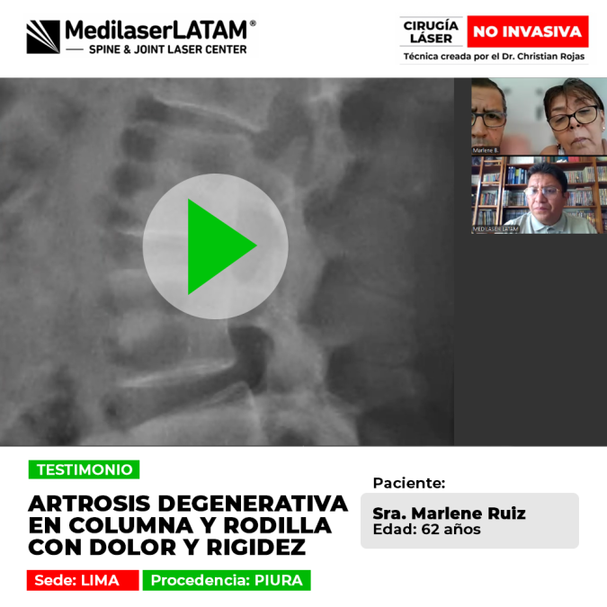 Marlene Ruiz (Piura) comparte cómo el láser detuvo la artrosis degenerativa en su columna y rodilla, eliminando el dolor y la rigidez.
