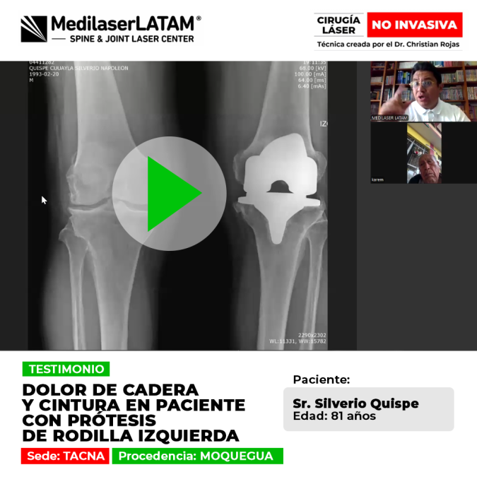 Dolor cadera prótesis de rodilla: Silverio Quispe (81) relata cómo el láser recuperó su cadera, a pesar de tener una prótesis previa.