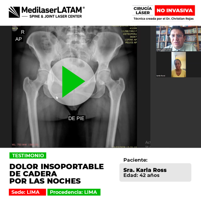 Testimonio: Dolor Cadera Nocturno insoportable en Karla Rossi (42). Descubra cómo la cirugía láser le devolvió el descanso y la tranquilidad.