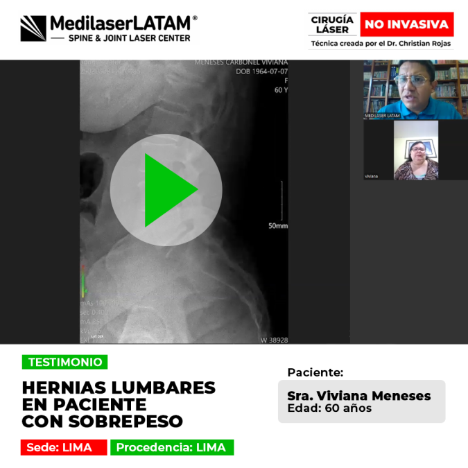 Testimonio: Hernias Sobrepeso Lumbar en Viviana Meneses (60). La cirugía láser resolvió su dolor de espalda sin cirugía abierta.