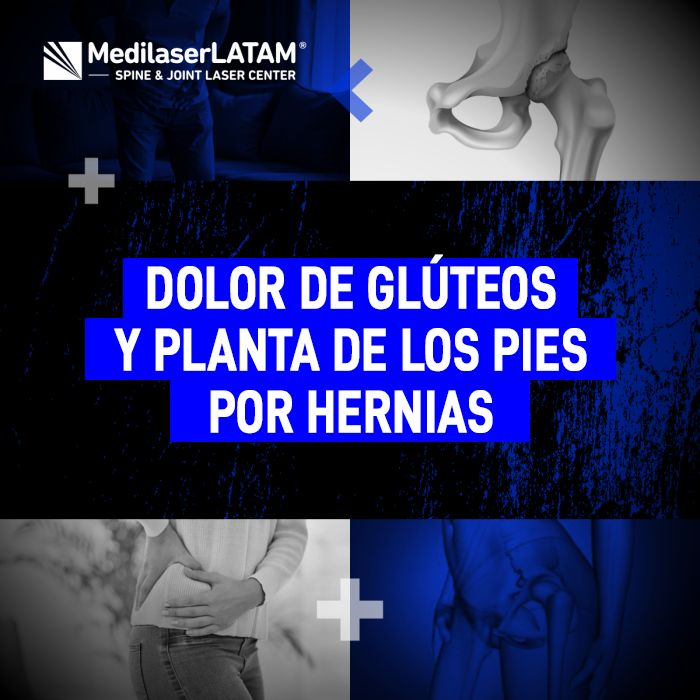 Dolor glúteos pies: ¿Ardor en la planta? El Dr. Rojas explica por qué estos síntomas son señal de una hernia lumbar que debe ser tratada con cirugía láser.