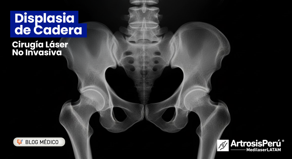 La Displasia de Cadera en adultos se complica con Artrosis, generando dolor y limitación. Conoce sus causas y la cirugía láser no invasiva para conservar tu cadera.