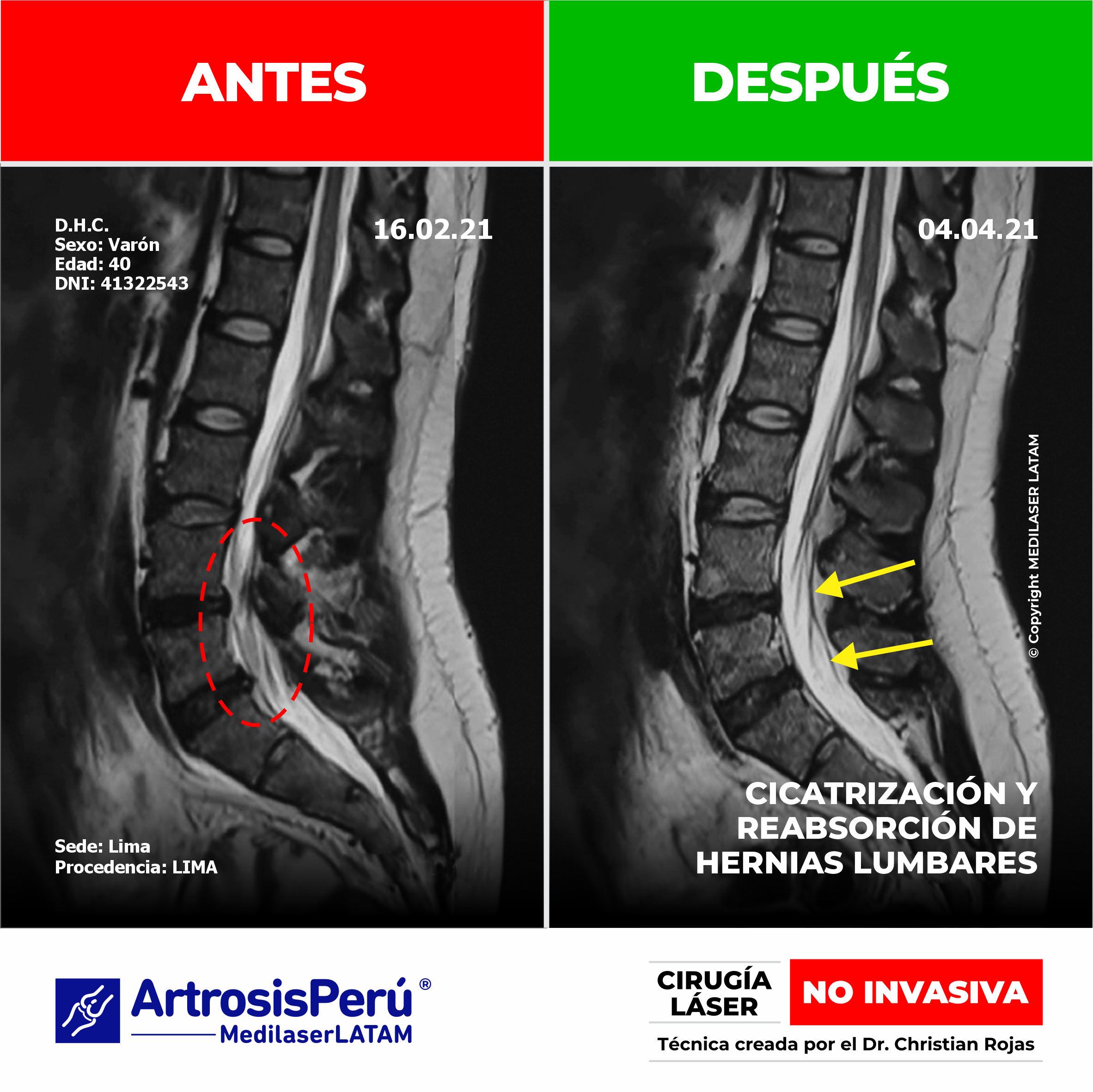 Reabsorción discal confirmada en David Honores. El tratamiento de columna NO INVASIVO con técnica láser del Dr. Christian Rojas