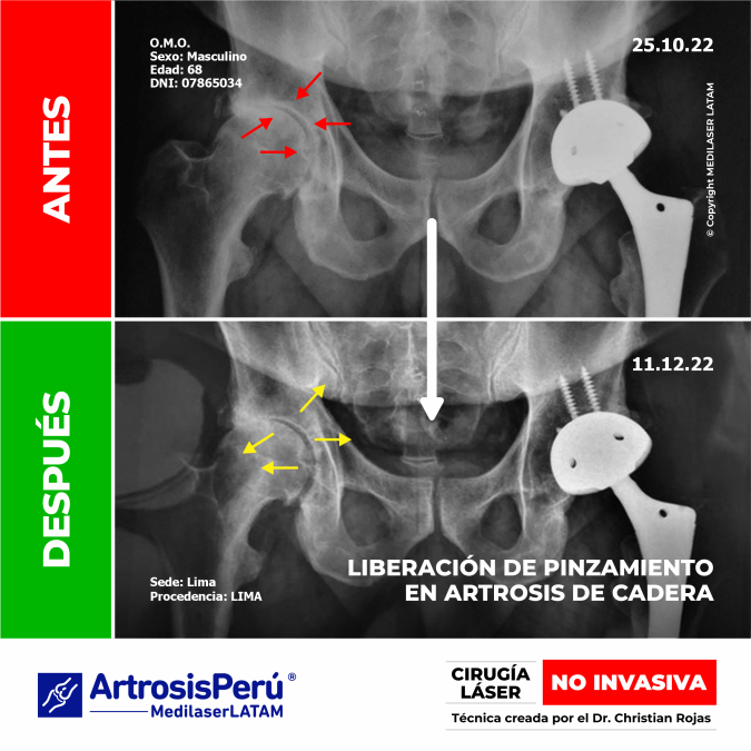 Pinzamiento Cadera: Descubre cómo se realiza la liberación del pinzamiento articular con técnicas avanzadas para tratar la Artrosis de Cadera.