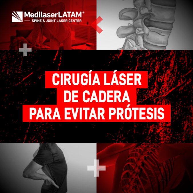 Cirugía láser de cadera: una alternativa para evitar la prótesis. Conoce los tiempos de recuperación y cómo soldar el cartílago sin cortes.