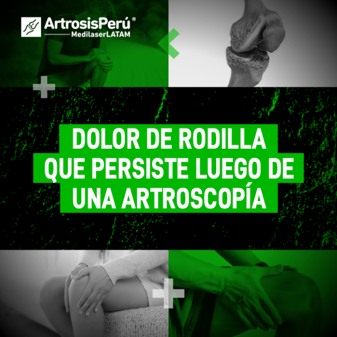 Dolor de rodilla tras una artroscopía: por qué la cirugía no siempre es la solución definitiva y cómo tratar la molestia persistente.