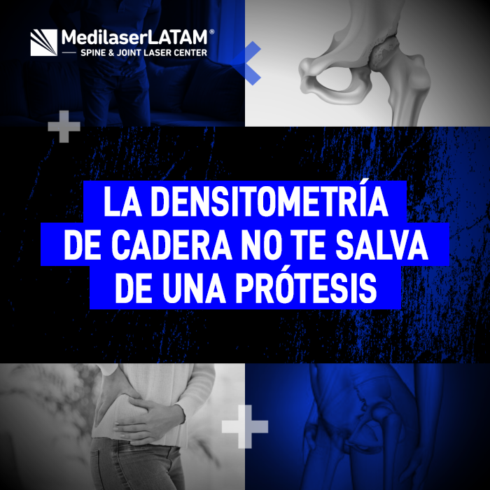 La densitometría de cadera no siempre detecta el desgaste del cartílago. Conoce por qué este examen no garantiza evitar una prótesis de cadera.