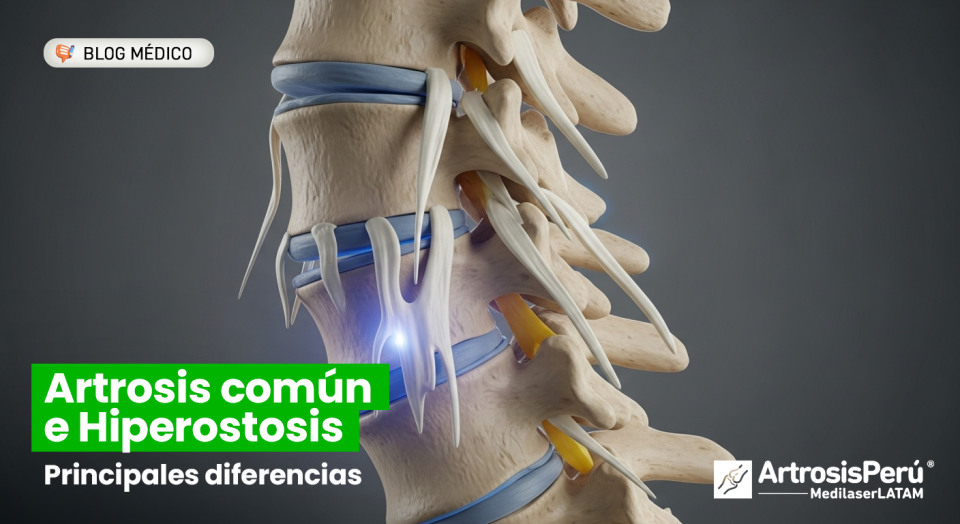 ¿Es artrosis o enfermedad de DISH? Descubre por qué se calcifica la columna y cómo detener la rigidez sin recurrir a cirugías invasivas.