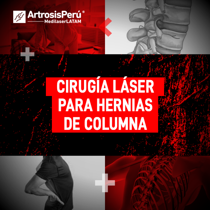 Descubre cómo funciona la cirugía láser para tratar Hernias de columna sin cortes. Información clave sobre tecnología médica avanzada.