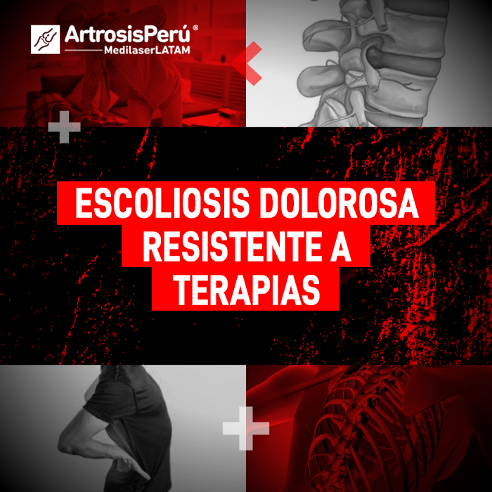 ¿Sufres de Escoliosis dolorosa que no mejora con terapias? Conoce las alternativas de tratamiento láser para aliviar el dolor persistente.