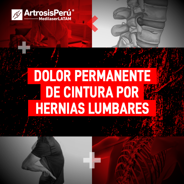 ¿Sufres de dolor permanente de cintura? Conoce cómo las Hernias lumbares afectan tu salud y las opciones de tratamiento láser sin cortes.