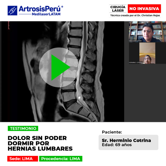Paciente logra recuperar el sueño y aliviar el dolor tras tratamiento para Hernias lumbares. Conoce su historia de éxito con tecnología láser.