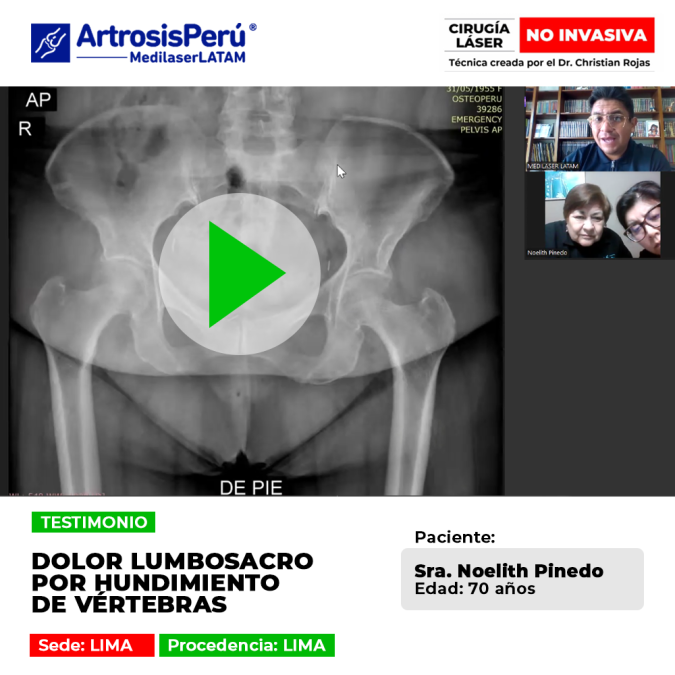 Testimonio de recuperación de dolor lumbosacro severo por Hundimiento de vértebras. Cirugía láser sin cortes para recuperar la movilidad.