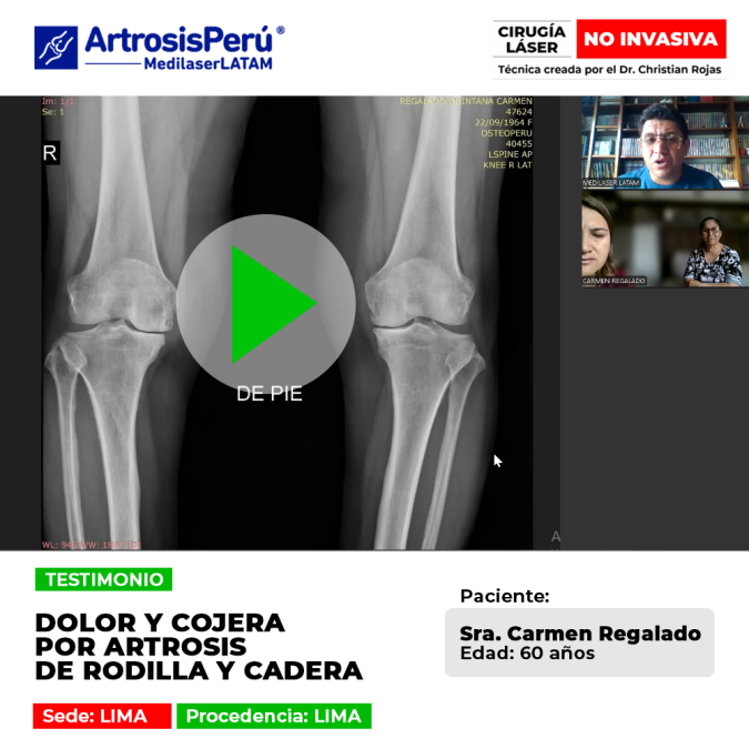 Paciente supera la cojera y el dolor crónico causado por Artrosis de rodilla y cadera. Descubre cómo volver a caminar con tratamiento láser.