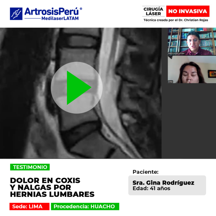 Testimonio sobre la eliminación del dolor en coxis y zona glútea causado por hernias lumbares. Descubre cómo el tratamiento láser evitó la cirugía.