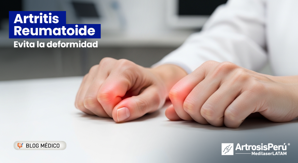 Artritis Reumatoide: conoce los síntomas tempranos y cómo proteger tus articulaciones antes de que el daño autoinmune sea permanente.