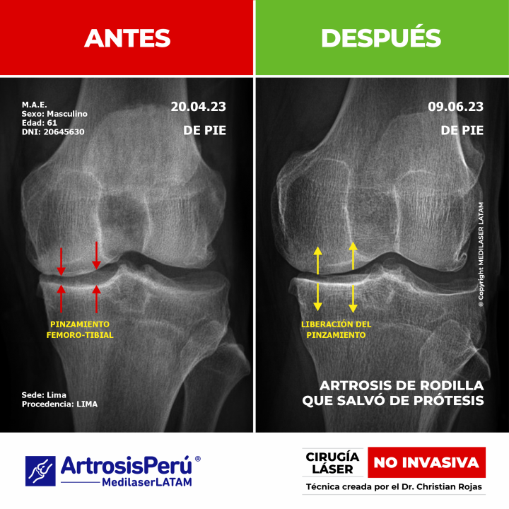 Artrosis de rodilla: evidencia científica de cómo el láser detiene el desgaste articular y elimina el dolor, evitando la prótesis.
