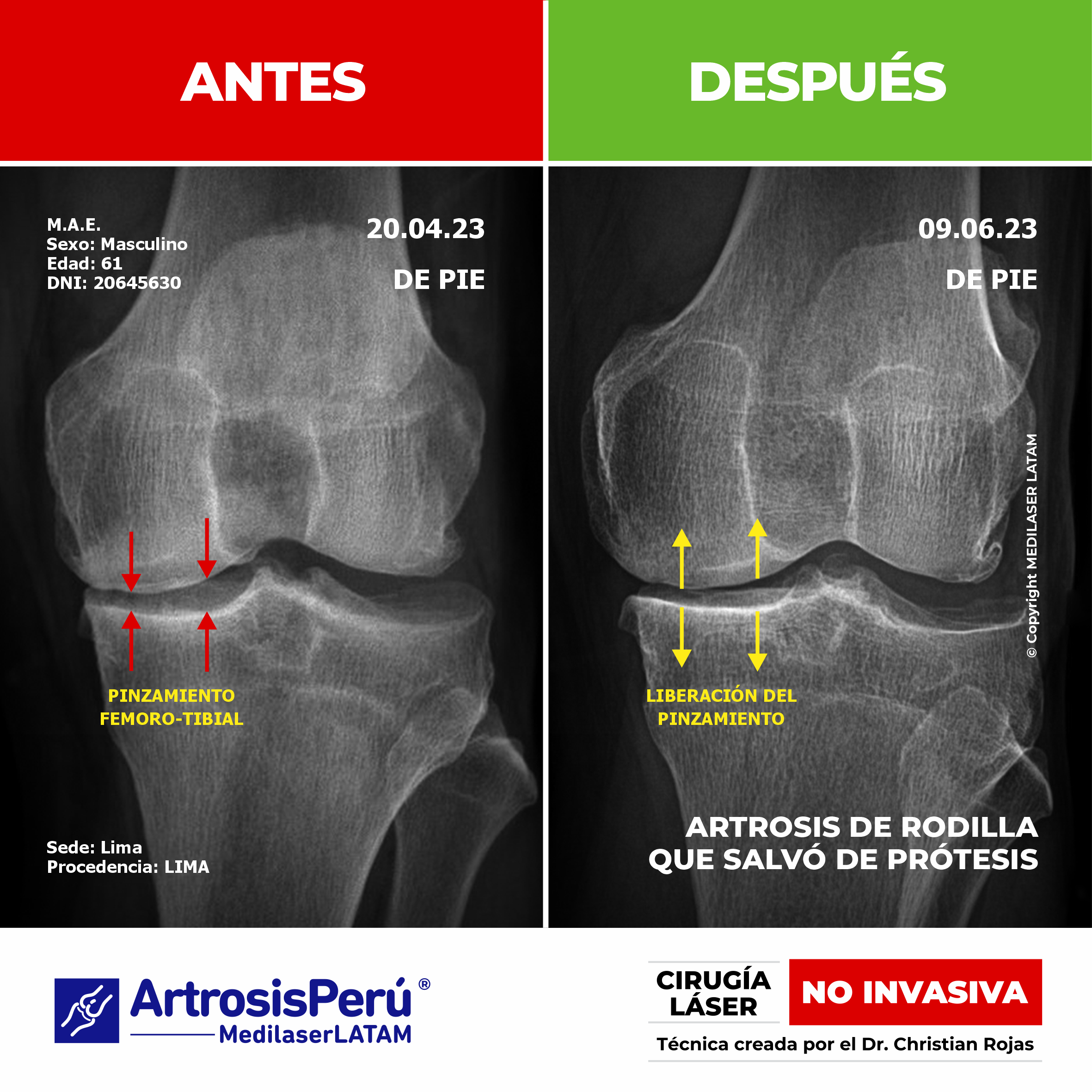 Artrosis de rodilla: evidencia científica de cómo el láser detiene el desgaste articular y elimina el dolor, evitando la prótesis.