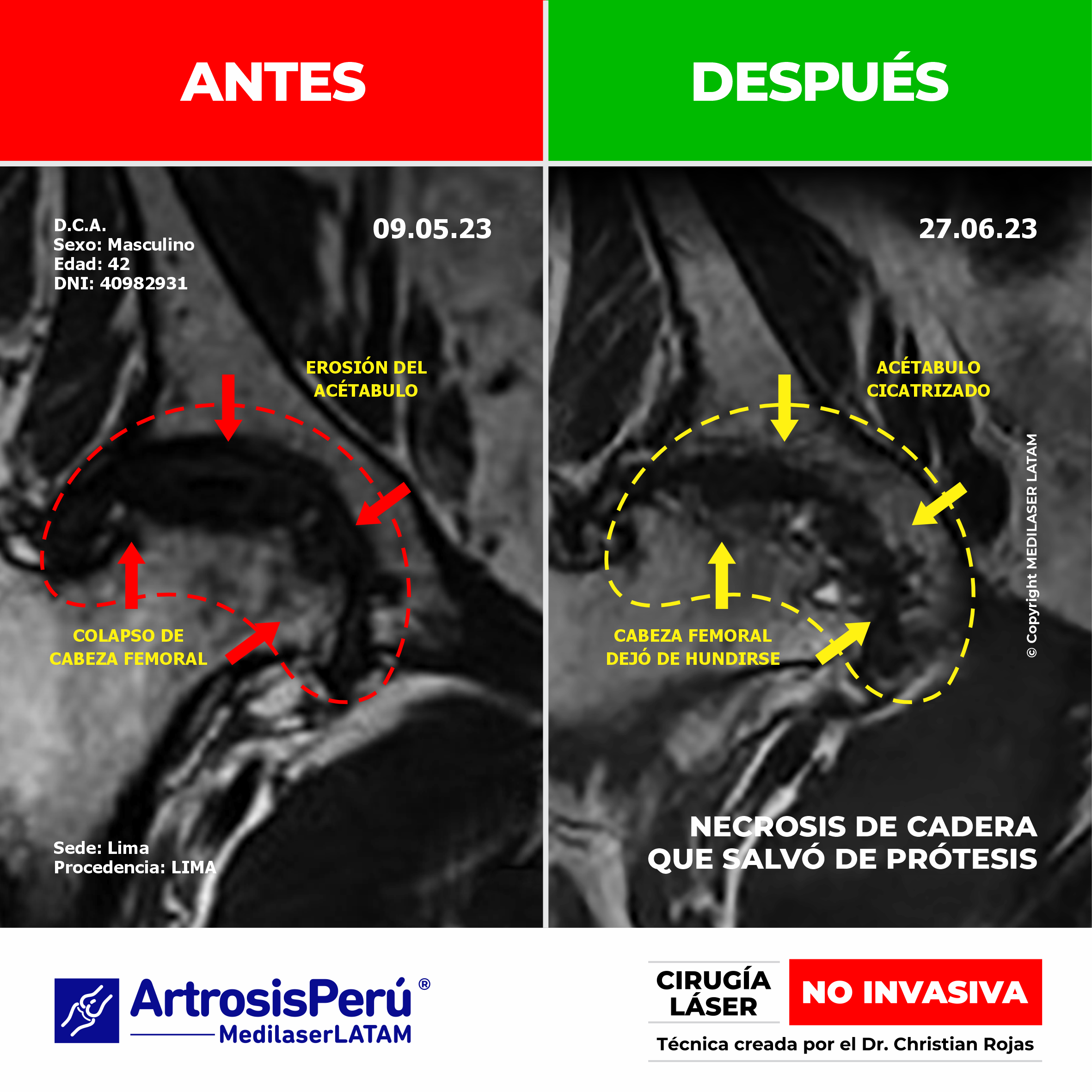 Necrosis de cadera: evidencia científica de reparación del tejido óseo con láser, evitando el reemplazo total de la articulación.