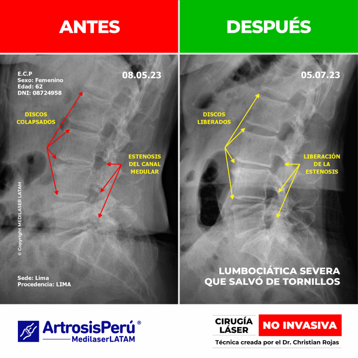 Lumbociática severa: evidencia de descompresión radicular con láser de alta potencia, evitando fijaciones metálicas y cirugía abierta.
