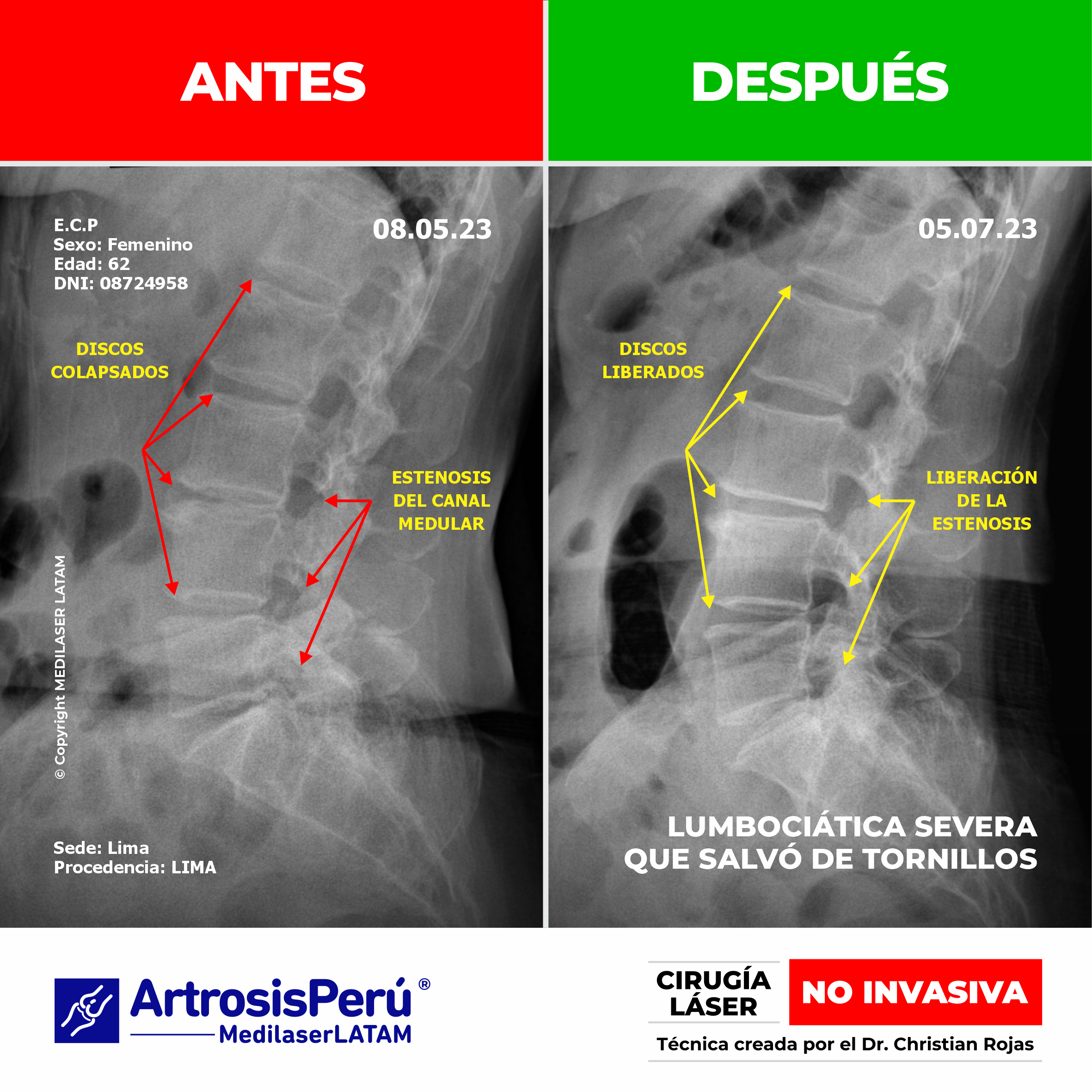 Lumbociática severa: evidencia de descompresión radicular con láser de alta potencia, evitando fijaciones metálicas y cirugía abierta.