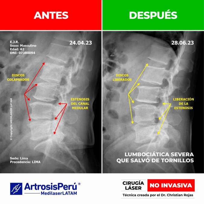 Tratamiento para lumbociática: evidencia científica de la eliminación de la compresión nerviosa sin uso de tornillos ni hospitalización.