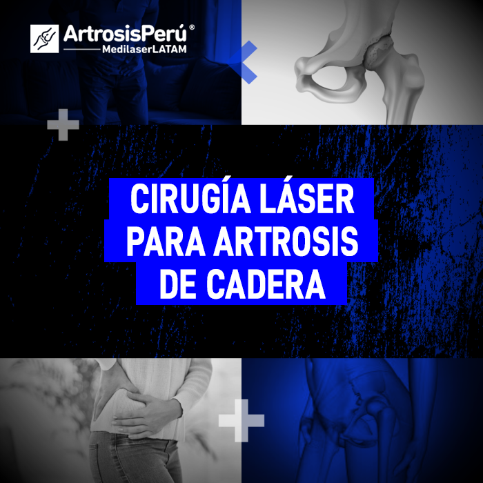 Cirugía láser para Artrosis de cadera: una alternativa avanzada y mínimamente invasiva para recuperar la movilidad sin usar prótesis.