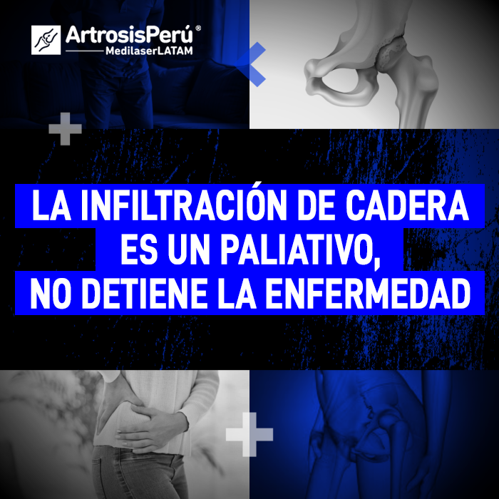 Infiltración de cadera es un paliativo. Descubre por qué este procedimiento no detiene la enfermedad con la explicación del Dr. Rojas.