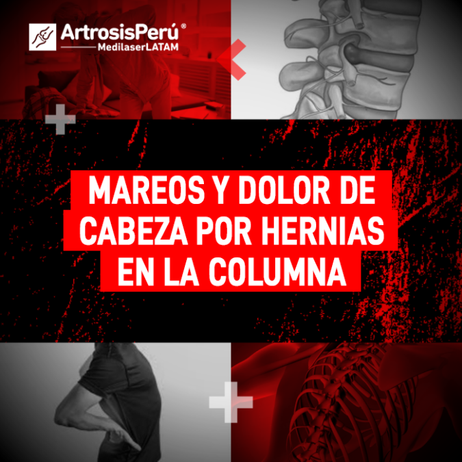 Mareos y dolor de cabeza causados por Hernias en la columna: análisis de síntomas y opciones de recuperación con tecnología láser.