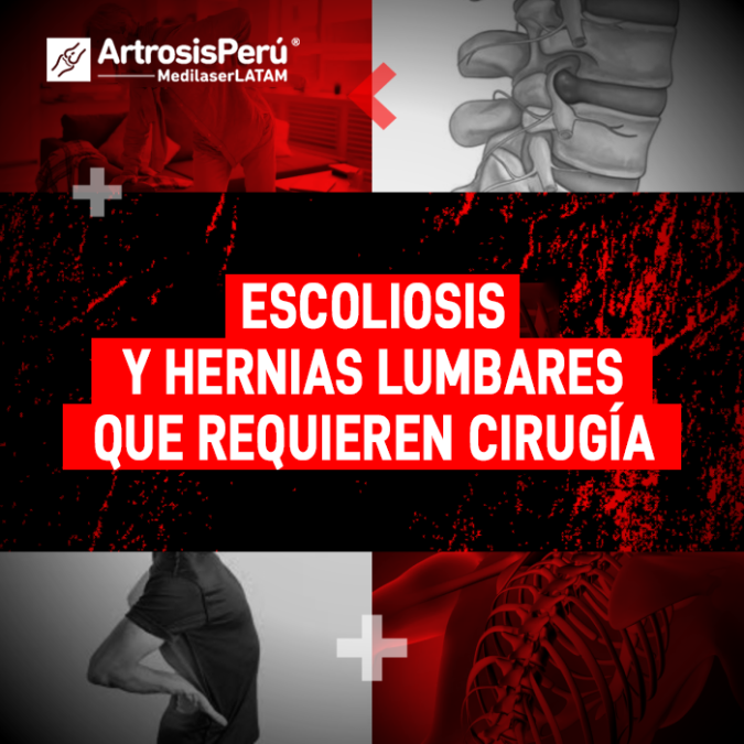 Escoliosis y Hernias lumbares: criterios médicos para determinar cuándo un paciente necesita una intervención quirúrgica en la columna.