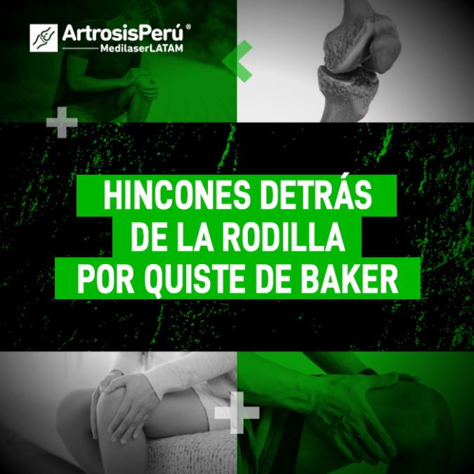 Quiste de Baker y los hincones detrás de la rodilla. Conoce más sobre esta afección y su tratamiento médico especializado en nuestro blog.