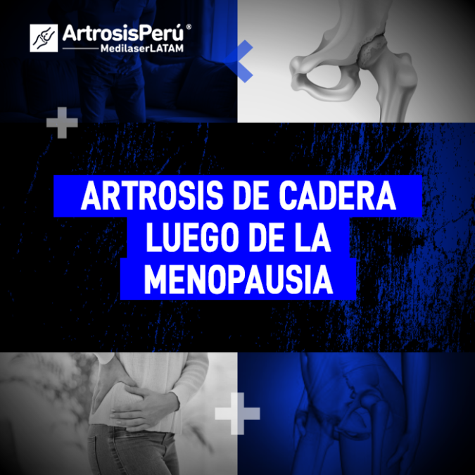 Artrosis de cadera tras la menopausia: descripción de la sintomatología articular y alternativas médicas para la regeneración y alivio.