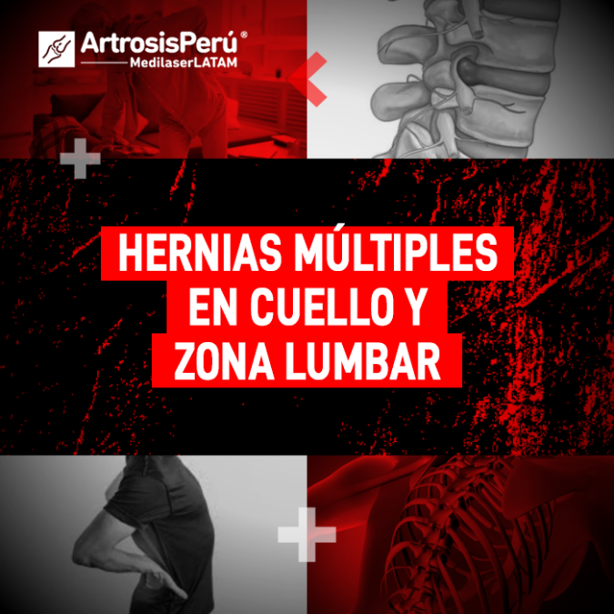 Hernias múltiples en cuello y zona lumbar. Aprende cómo tratar varias hernias simultáneamente con tecnología láser avanzada en Medilaser.